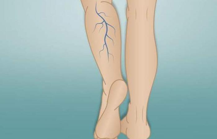 تعرف على علاج الدوالي وأهم الأعراض وأسباب الإصابة