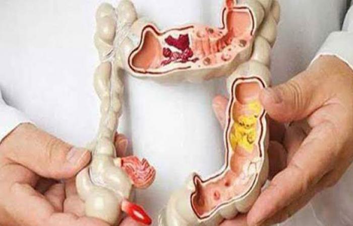 أعراض سرطان المستقيم وطرق الوقاية منه