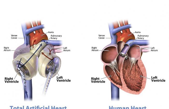 قصة أول عملية زرع قلب صناعى بالتاريخ فى ذكراها الثامنة