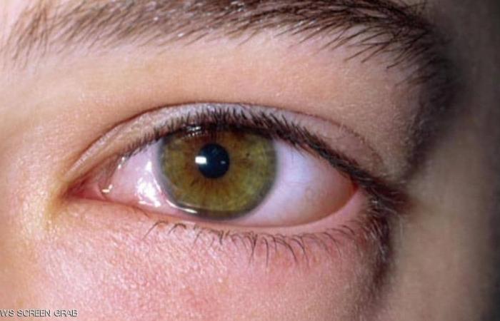 هل كورونا يصيب الأطفال بمضاعفات نادرة في العيون؟.. حالة مرضية تكشف التفاصيل