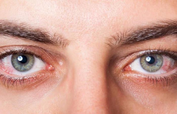 4 أعراض تكشف عن الإصابة بـ«جفاف العين»