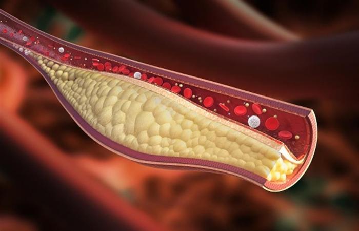 ارتفاع الكوليسترول: خطر صامت يهدد صحة القلب والأوعية الدمويةالجمعة 28/فبراير/2025 - 07:27 م
يُعد ارتفاع نسبة الكوليسترول في الدم من المشكلات الصحية الشائعة التي ترتبط ارتباطًا وثيقًا بالعديد من الأمراض الخطيرة، مثل أمراض القلب التاجية والسكتات الدماغية.
