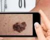 تطبيق جديد يستخدم الذكاء الاصطناعى لتصنيف حالات سرطان الجلد بالتقاط صورة